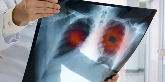 Geçmeyen öksürük ve nefes darlığına dikkat!